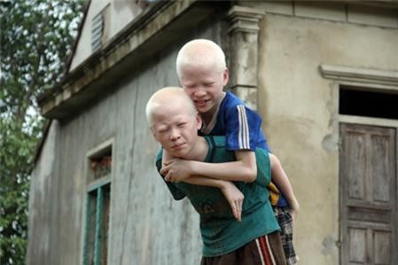 Cách biện pháp phòng ngừa tiến triển của bệnh bạch tạng